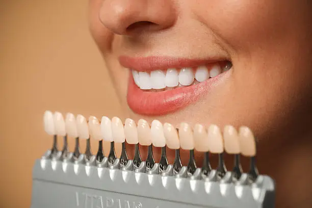 Sorriso perfetto con trattamenti di estetica dentale — Studio Dentistico Bordini Quadrelli